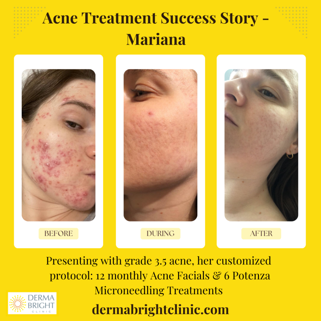 Acne treatment Vancouver